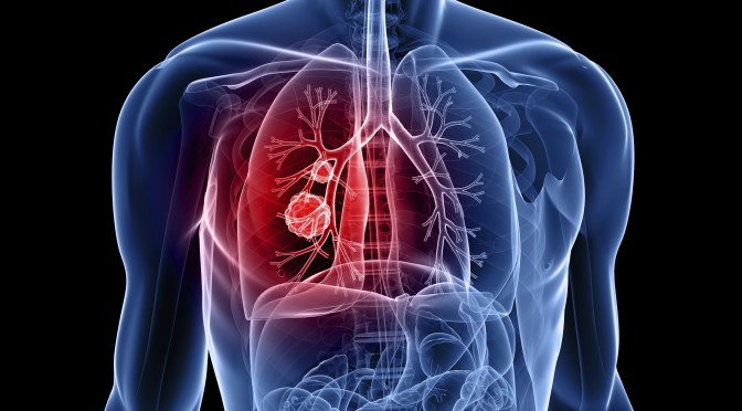 lung-cancer